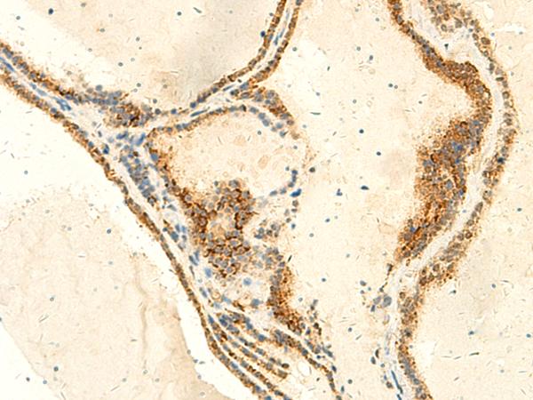 NKD2 Antibody - Immunohistochemistry of paraffin-embedded Human thyroid cancer tissue  using NKD2 Polyclonal Antibody at dilution of 1:50(×200)