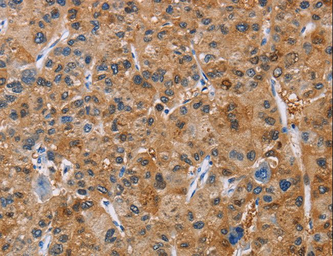 NKP30 Antibody - Immunohistochemistry of paraffin-embedded Human liver cancer using NCR3 Polyclonal Antibody at dilution of 1:40.