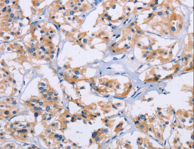 NKP30 Antibody - Immunohistochemistry of paraffin-embedded Human thyroid cancer using NCR3 Polyclonal Antibody at dilution of 1:40.