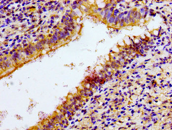 NKP30 Antibody - Immunohistochemistry image of paraffin-embedded human lung cancer at a dilution of 1:100
