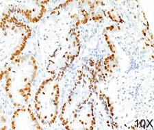 NKX2-1 / Thyroid-Specific TF Antibody - TTF1 antibody 8G7G3/1 immunohistochemistry lung adenocarcinoma 10X This image was taken for the unmodified form of this product. Other forms have not been tested.