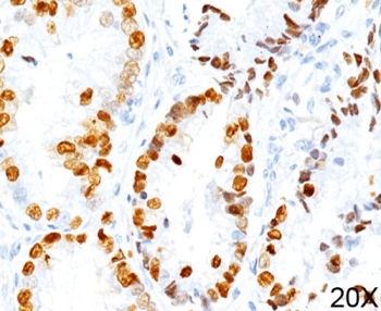 NKX2-1 / Thyroid-Specific TF Antibody - TTF1 antibody 8G7G3/1 immunohistochemistry lung adenocarcinoma 20X This image was taken for the unmodified form of this product. Other forms have not been tested.