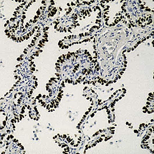 NKX2-1 / Thyroid-Specific TF Antibody - Formalin-fixed, paraffin-embedded human lung stained with TTF-1 antibody.