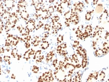 NKX2-1 / Thyroid-Specific TF Antibody - Formalin-fixed, paraffin-embedded human thyroid stained with TTF1 antibody (8G7G3/1 + NX2.1/690).  This image was taken for the unmodified form of this product. Other forms have not been tested.