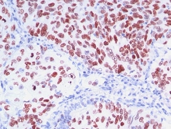 NKX2-1 / Thyroid-Specific TF Antibody - Formalin-fixed, paraffin-embedded human lung carcinoma stained with TTF1 antibody (8G7G3/1 + NX2.1/690).  This image was taken for the unmodified form of this product. Other forms have not been tested.