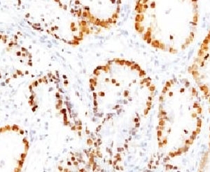 NKX2-1 / Thyroid-Specific TF Antibody - IHC testing of FFPE human lung tissue with TTF1 antibody (clone HBNK2-1).  This image was taken for the unmodified form of this product. Other forms have not been tested.