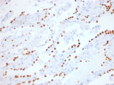 NKX2-1 / Thyroid-Specific TF Antibody - Formalin-fixed, paraffin-embedded human Lung Adenocarcinoma stained with TTF-1 Rabbit Recombinant Monoclonal Antibody (NX2.1/1855R).