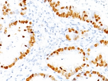 NKX2-1 / Thyroid-Specific TF Antibody - Formalin-fixed, paraffin-embedded human lung Adenocarcinoma stained with TTF1 antibody (NX2.1/690).  This image was taken for the unmodified form of this product. Other forms have not been tested.