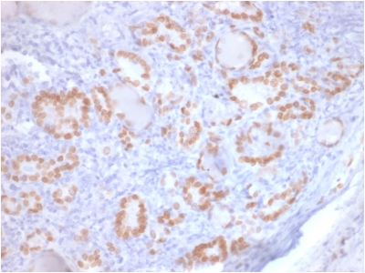 NKX2-1 / Thyroid-Specific TF Antibody - Formalin-fixed, paraffin-embedded human Lung Adenocarcinomastained with TTF-1 Mouse Recombinant Monoclonal Antibody (rNX2.1/690).