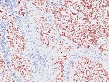 NKX2-1 / Thyroid-Specific TF Antibody - Formalin-fixed, paraffin-embedded human lung carcinoma stained with NKX2.1 antibody (SPM150).  This image was taken for the unmodified form of this product. Other forms have not been tested.