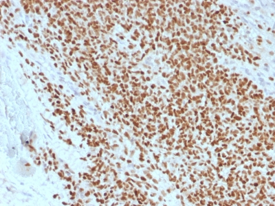 NKX2-2 Antibody - Formalin-fixed, paraffin-embedded human Ewing’s Sarcoma stained with NKX2.2 Mouse Recombinant Monoclonal Antibody (rNX2/1523).