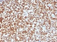 NKX2-2 Antibody - IHC testing of FFPE Ewings sarcoma with NKX2.2 antibody. HIER: steam sections in 10mM citrate buffer, pH 6.0, for 10-20 min.