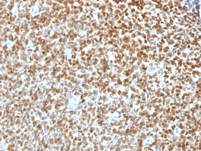 NKX2-2 Antibody - Formalin-fixed, paraffin-embedded human Ewing’s Sarcoma stained with NKX2.2 Rabbit Recombinant Monoclonal Antibody (NX2/1422R).