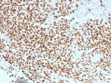 NKX2-2 Antibody - IHC testing of FFPE Ewings sarcoma with NKX2.2 antibody (clone NX2/1523). HIER: steam sections in 10mM citrate buffer, pH 6.0, for 10-20 min.