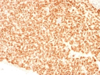 NKX2-2 Antibody - IHC testing of FFPE Ewings sarcoma with NKX2.2 antibody (clone NX2/1523). HIER: steam sections in 10mM citrate buffer, pH 6.0, for 10-20 min.