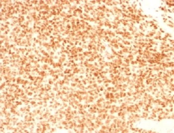NKX2-2 Antibody - IHC testing of FFPE Ewings sarcoma with NKX2.2 antibody (clone NX2/1524). HIER: steam sections in 10mM citrate buffer, pH 6, for 10-20 min.