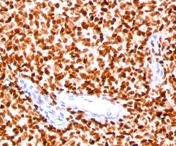 NKX2-2 Antibody - NKX2.2 antibody NX2/294 immunohistochemistry Ewings sarcoma.  This image was taken for the unmodified form of this product. Other forms have not been tested.