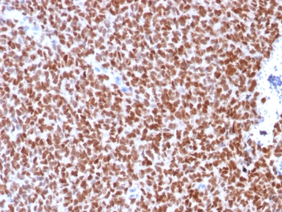 NKX2-2 Antibody - Formalin-fixed, paraffin-embedded human Ewing’s Sarcoma stained with NKX2.2 Mouse Recombinant Monoclonal Antibody (rNX2/294).