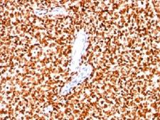 NKX2-2 Antibody - Formalin-fixed paraffin-embedded human Ewing's sarcoma stained with NKX2.2 antibody (SPM564).  This image was taken for the unmodified form of this product. Other forms have not been tested.