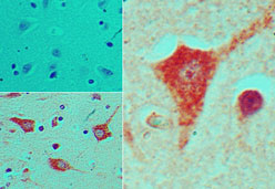 NKX2-5 Antibody - IHC of NKX2-5 in formalin-fixed, paraffin-embedded human brain tissue using an isotype control (top left) and Polyclonal Antibody to NKX2-5 (bottom left, right) at 5 ug/ml.