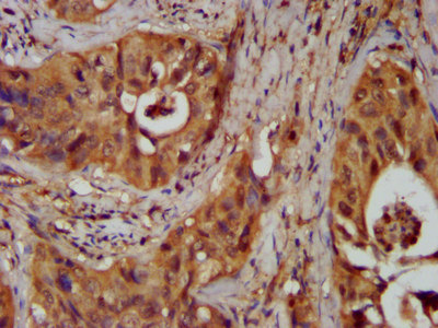NKX2-8 Antibody - Immunohistochemistry image at a dilution of 1:300 and staining in paraffin-embedded human cervical cancer performed on a Leica BondTM system. After dewaxing and hydration, antigen retrieval was mediated by high pressure in a citrate buffer (pH 6.0) . Section was blocked with 10% normal goat serum 30min at RT. Then primary antibody (1% BSA) was incubated at 4 °C overnight. The primary is detected by a biotinylated secondary antibody and visualized using an HRP conjugated SP system.