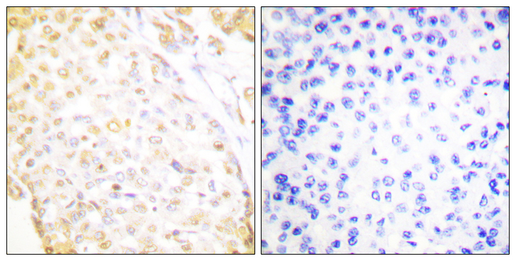 NKX3-1 Antibody - Immunohistochemistry analysis of paraffin-embedded human breast carcinoma, using NKX3.1 Antibody. The picture on the right is blocked with the synthesized peptide.