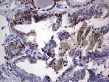 NKX3-1 Antibody - IHC of paraffin-embedded Carcinoma of Human prostate tissue using anti-NKX3-1 mouse monoclonal antibody. (Heat-induced epitope retrieval by 1 mM EDTA in 10mM Tris, pH8.5, 120°C for 3min).