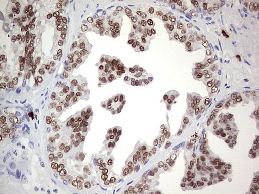 NKX3-1 Antibody - Immunohistochemical staining of paraffin-embedded Carcinoma of Human prostate tissue using anti-NKX3-1 mouse monoclonal antibody. (Heat-induced epitope retrieval by 1 mM EDTA in 10mM Tris, pH8.5, 120C for 3min,