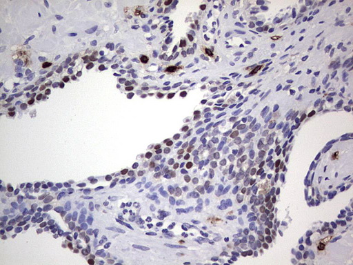 NKX3-1 Antibody - IHC of paraffin-embedded Human prostate tissue using anti-NKX3-1 mouse monoclonal antibody. (Heat-induced epitope retrieval by 1 mM EDTA in 10mM Tris, pH8.5, 120°C for 3min).