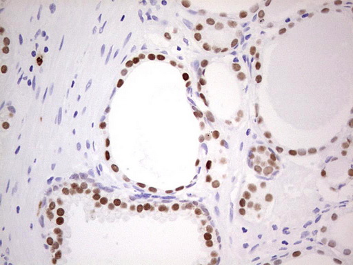 NKX3-1 Antibody - Immunohistochemical staining of paraffin-embedded Carcinoma of Human prostate tissue using anti-NKX3-1 mouse monoclonal antibody.  Dilution: 1:150
