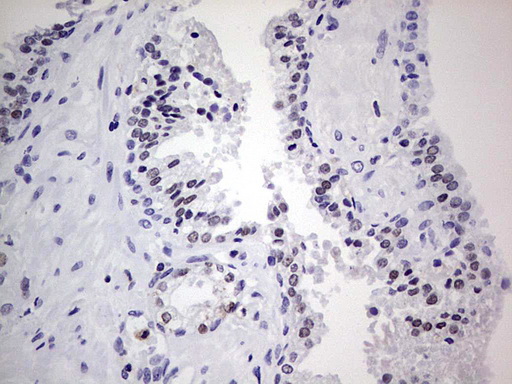 NKX3-1 Antibody - IHC of paraffin-embedded Carcinoma of Human prostate tissue using anti-NKX3-1 mouse monoclonal antibody. (Heat-induced epitope retrieval by 1 mM EDTA in 10mM Tris, pH8.5, 120°C for 3min).