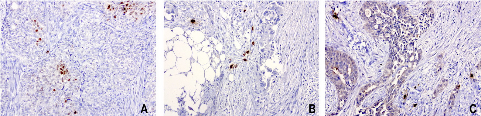 NKX3-1 Antibody - Immunohistochemical staining of 3 cases of paraffin-embedded human endometrial carcinoma using anti-NKX3.1 clone UMAB195 mouse monoclonal antibody  at 1:100 with Polink2 Broad HRP DAB detection kit; heat-induced epitope retrieval with GBI ACCEL pH8.7 HIER buffer using pressure chamber for 3 minutes at 110C. No staining seen in the tumor cells but some cytoplasmic staining was visualized in the third case along with weak nuclear staining.