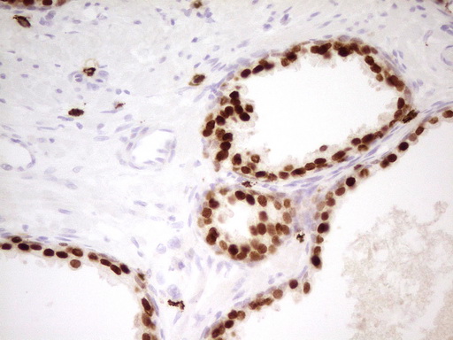 NKX3-1 Antibody - Immunohistochemical staining of paraffin-embedded Carcinoma of Human prostate tissue using anti-NKX3-1 mouse monoclonal antibody. (Heat-induced epitope retrieval by 1mM EDTA in 10mM Tris buffer. (pH8.0) at 120C for 3 min. (1:200)