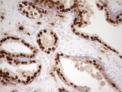 NKX3-1 Antibody - Immunohistochemical staining of paraffin-embedded Human prostate tissue using anti-NKX3-1 mouse monoclonal antibody. (Heat-induced epitope retrieval by 1mM EDTA in 10mM Tris buffer. (pH8.0) at 120C for 3 min. (1:200)