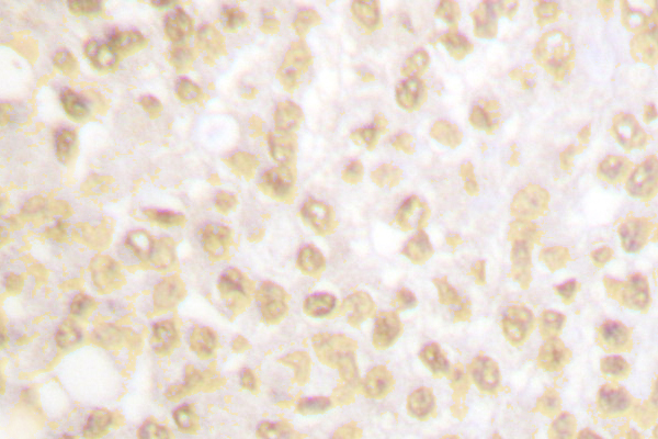 NKX3-1 Antibody - IHC of NKX3.1 (L2) pAb in paraffin-embedded human breast carcinoma tissue.