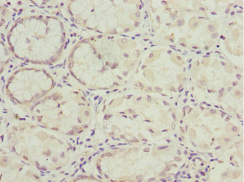 NLE1 Antibody - Immunohistochemistry of paraffin-embedded human gastric cancer at dilution 1:100