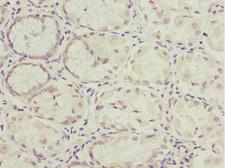 NLE1 Antibody - Immunohistochemistry of paraffin-embedded human gastric cancer at dilution 1:100