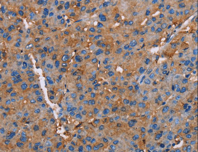 NLGN1 / Neuroligin 1 Antibody - Immunohistochemistry of paraffin-embedded Human liver cancer using NLGN1 Polyclonal Antibody at dilution of 1:50.
