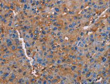 NLGN1 / Neuroligin 1 Antibody - Immunohistochemistry of paraffin-embedded Human liver cancer using NLGN1 Polyclonal Antibody at dilution of 1:50.