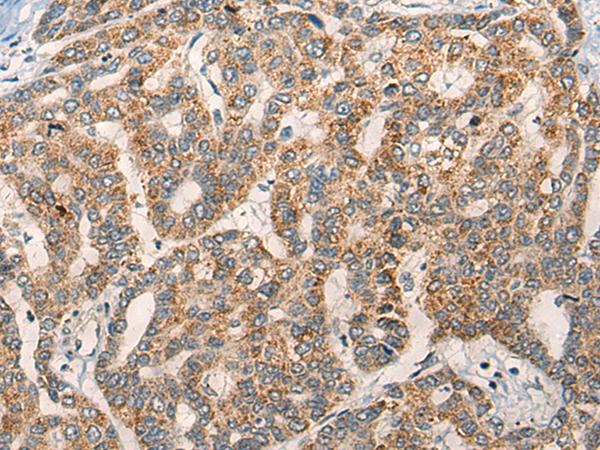 NLGN1 / Neuroligin 1 Antibody - Immunohistochemistry of paraffin-embedded Human liver cancer tissue  using NLGN1 Polyclonal Antibody at dilution of 1:50(×200)