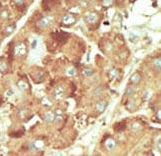 NLK Antibody - Formalin-fixed and paraffin-embedded human cancer tissue reacted with the primary antibody, which was peroxidase-conjugated to the secondary antibody, followed by DAB staining. This data demonstrates the use of this antibody for immunohistochemistry; clinical relevance has not been evaluated. BC = breast carcinoma; HC = hepatocarcinoma.
