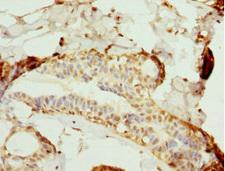 NLK Antibody - Immunohistochemistry of paraffin-embedded human breast cancer tissue at dilution 1:100