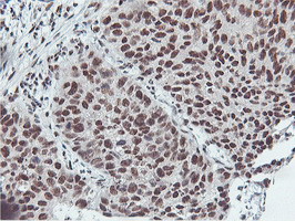 NLN / Neurolysin Antibody - IHC of paraffin-embedded Carcinoma of Human lung tissue using anti-NLN mouse monoclonal antibody. (Heat-induced epitope retrieval by 10mM citric buffer, pH6.0, 100C for 10min).