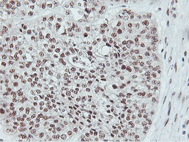 NLN / Neurolysin Antibody - IHC of paraffin-embedded Adenocarcinoma of Human ovary tissue using anti-NLN mouse monoclonal antibody. (Heat-induced epitope retrieval by 10mM citric buffer, pH6.0, 100C for 10min).
