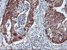 NLN / Neurolysin Antibody - IHC of paraffin-embedded Carcinoma of Human pancreas tissue using anti-NLN mouse monoclonal antibody.