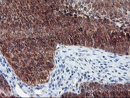 NLN / Neurolysin Antibody - IHC of paraffin-embedded Carcinoma of Human bladder tissue using anti-NLN mouse monoclonal antibody.