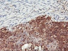 NLN / Neurolysin Antibody - IHC of paraffin-embedded Adenocarcinoma of Human ovary tissue using anti-NLN mouse monoclonal antibody.