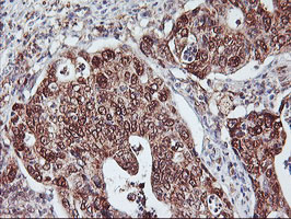 NLN / Neurolysin Antibody - IHC of paraffin-embedded Carcinoma of Human pancreas tissue using anti-NLN mouse monoclonal antibody.