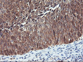 NLN / Neurolysin Antibody - IHC of paraffin-embedded Carcinoma of Human bladder tissue using anti-NLN mouse monoclonal antibody.