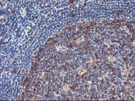 NLN / Neurolysin Antibody - IHC of paraffin-embedded Human lymphoma tissue using anti-NLN mouse monoclonal antibody.